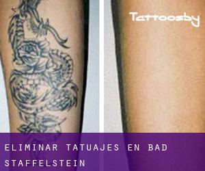 Eliminar tatuajes en Bad Staffelstein