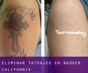 Eliminar tatuajes en Badger (California)