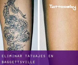 Eliminar tatuajes en Baggettsville