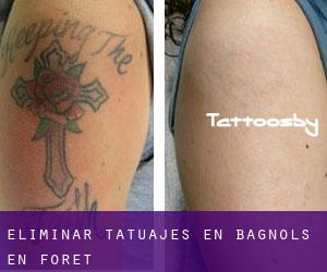 Eliminar tatuajes en Bagnols-en-Forêt