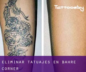Eliminar tatuajes en Bahre Corner