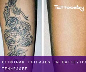 Eliminar tatuajes en Baileyton (Tennessee)