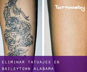 Eliminar tatuajes en Baileytown (Alabama)