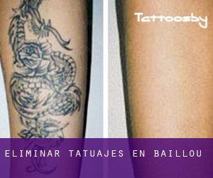 Eliminar tatuajes en Baillou