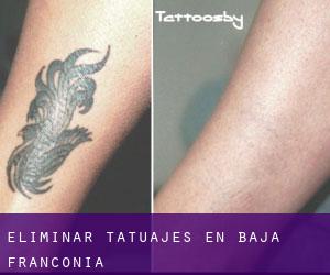 Eliminar tatuajes en Baja Franconia