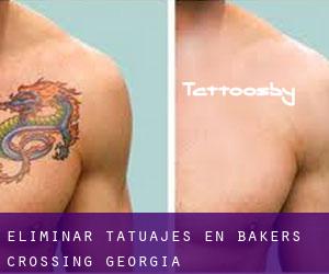 Eliminar tatuajes en Bakers Crossing (Georgia)