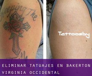 Eliminar tatuajes en Bakerton (Virginia Occidental)