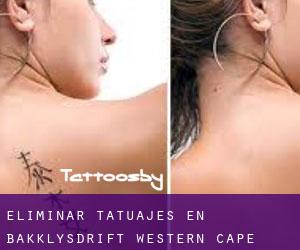 Eliminar tatuajes en Bakklysdrift (Western Cape)