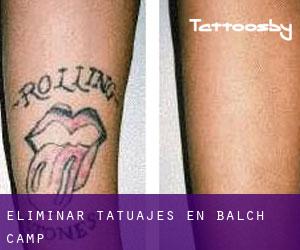Eliminar tatuajes en Balch Camp