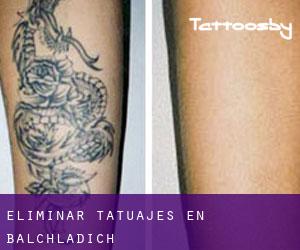Eliminar tatuajes en Balchladich