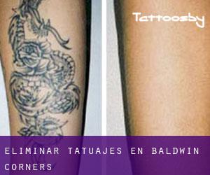 Eliminar tatuajes en Baldwin Corners
