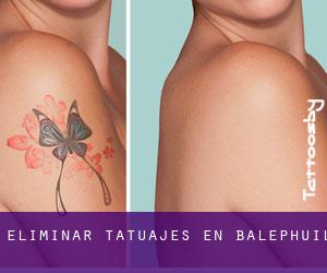 Eliminar tatuajes en Balephuil