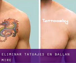Eliminar tatuajes en Ballan-Miré