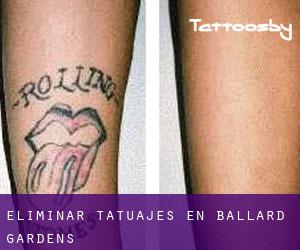 Eliminar tatuajes en Ballard Gardens