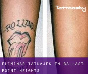 Eliminar tatuajes en Ballast Point Heights