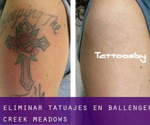 Eliminar tatuajes en Ballenger Creek Meadows