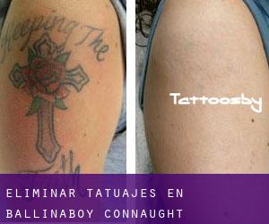 Eliminar tatuajes en Ballinaboy (Connaught)