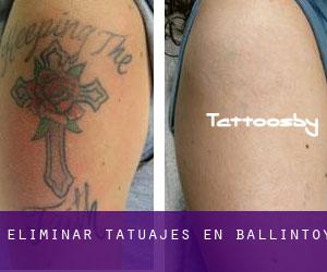 Eliminar tatuajes en Ballintoy