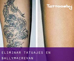 Eliminar tatuajes en Ballymacrevan
