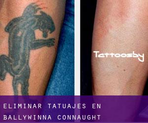 Eliminar tatuajes en Ballywinna (Connaught)