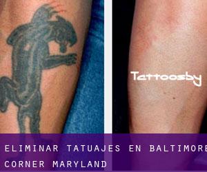 Eliminar tatuajes en Baltimore Corner (Maryland)