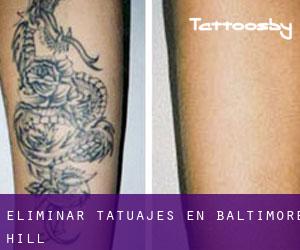 Eliminar tatuajes en Baltimore Hill
