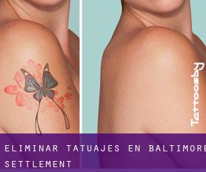 Eliminar tatuajes en Baltimore Settlement