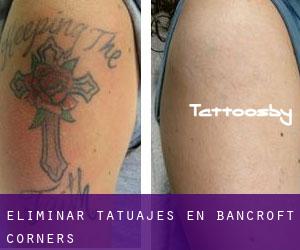 Eliminar tatuajes en Bancroft Corners