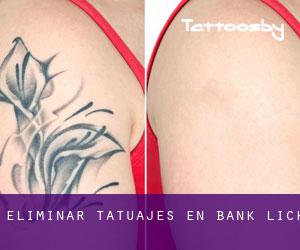 Eliminar tatuajes en Bank Lick