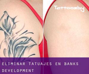 Eliminar tatuajes en Banks Development