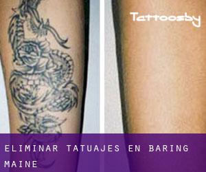 Eliminar tatuajes en Baring (Maine)