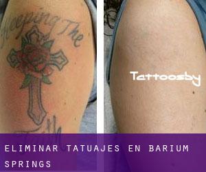Eliminar tatuajes en Barium Springs
