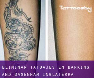 Eliminar tatuajes en Barking and Dagenham (Inglaterra)