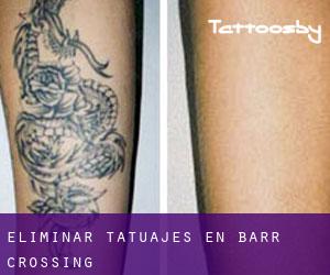 Eliminar tatuajes en Barr Crossing