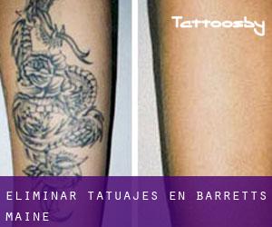 Eliminar tatuajes en Barretts (Maine)