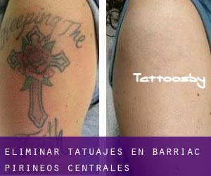 Eliminar tatuajes en Barriac (Pirineos Centrales)