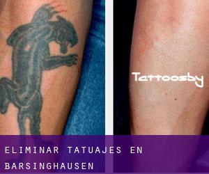 Eliminar tatuajes en Barsinghausen