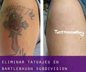 Eliminar tatuajes en Bartlebaugh Subdivision