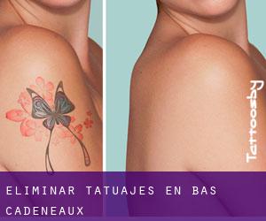 Eliminar tatuajes en Bas Cadeneaux