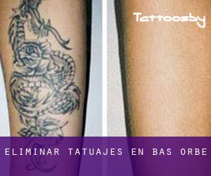 Eliminar tatuajes en Bas-Orbé