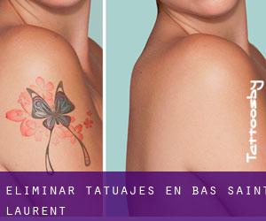 Eliminar tatuajes en Bas-Saint-Laurent