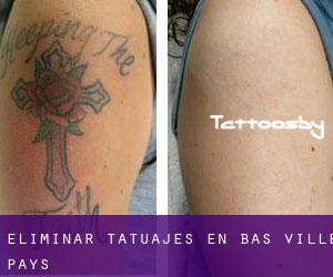 Eliminar tatuajes en Bas Ville-Pays