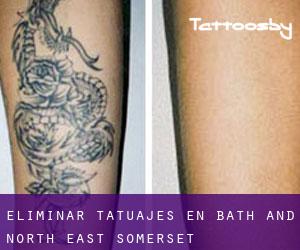 Eliminar tatuajes en Bath and North East Somerset