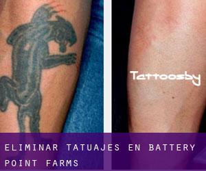 Eliminar tatuajes en Battery Point Farms