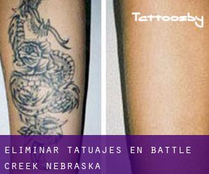 Eliminar tatuajes en Battle Creek (Nebraska)
