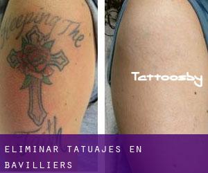 Eliminar tatuajes en Bavilliers