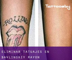 Eliminar tatuajes en Bavlinskiy Rayon