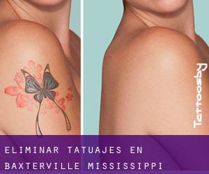 Eliminar tatuajes en Baxterville (Mississippi)