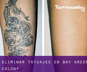 Eliminar tatuajes en Bay Green Colony