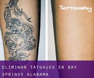 Eliminar tatuajes en Bay Springs (Alabama)